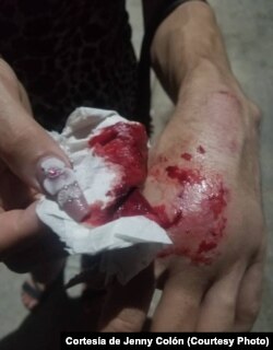 Imagen de la mano de una de las mujeres trans agredidas en Cárdenas (Cortesía de Jenny Colón)